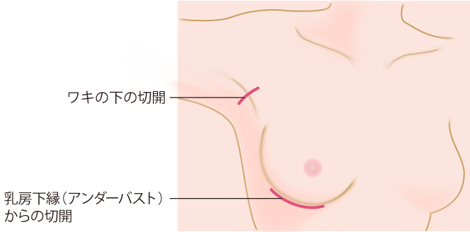 脇の下の切開と乳房下縁（アンダーバスト）からの切開の位置