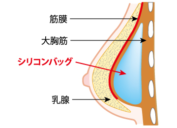 胸断面図 シリコンバッグと乳腺と筋膜と大胸筋