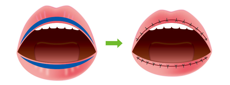 口唇縮小術