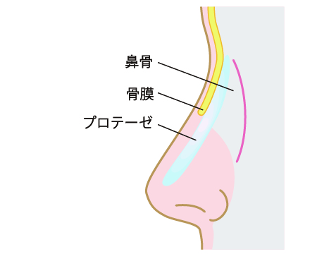 鼻骨、骨膜、プロテーゼ