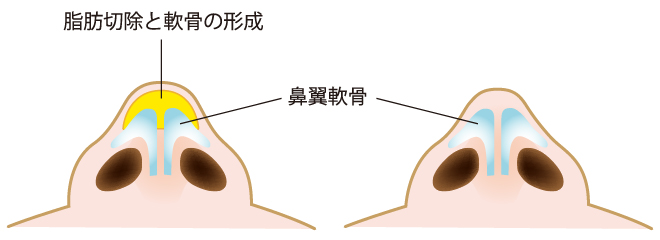 脂肪切除と軟骨の形成と鼻翼軟骨
