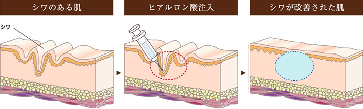 シワのある肌 ヒアルロン酸注入 シワが改善された肌