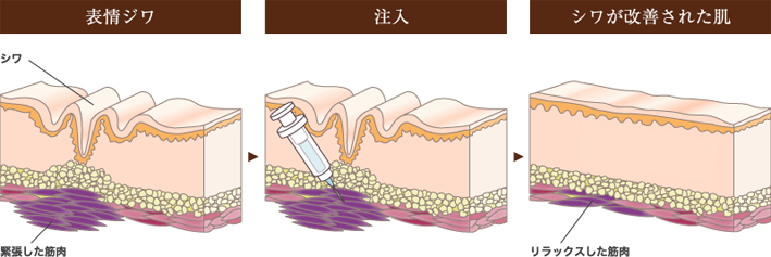 表情ジワ 注入 シワが改善された肌