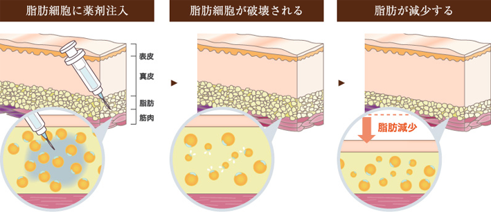 脂肪細胞に薬剤注入 脂肪組織が破壊される 脂肪が減少する