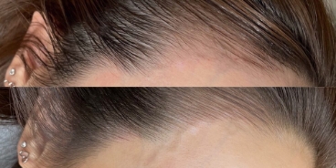 頭皮ヘアライン・スカルプ
