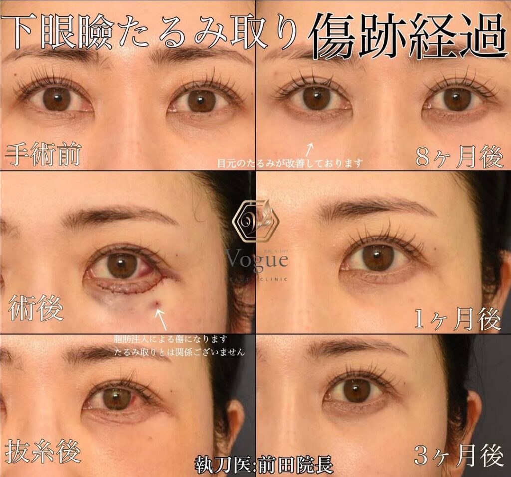 目 の クマ 消し方