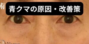 青クマとは?その原因と効果的な改善策やカバー方法を知ろう!