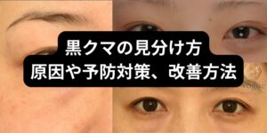 黒クマの見分け方とは？原因や予防対策、改善方法もチェック！