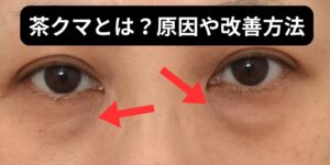 茶クマとは？茶クマができる原因や改善方法、予防対策もご紹介