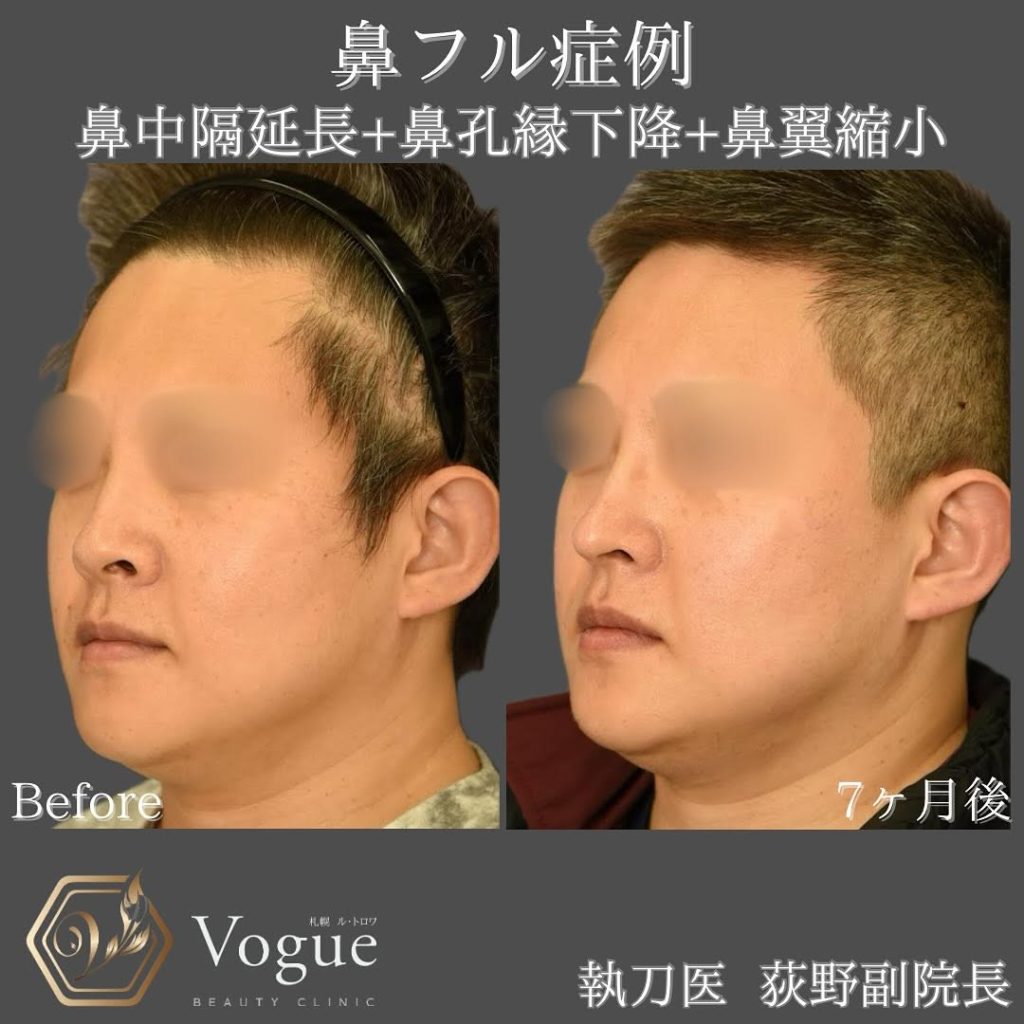 鼻翼 鼻孔縁下降・挙上 | 札幌ル・トロワ ビューティクリニックVogue｜美容外科・形成外科・皮膚科