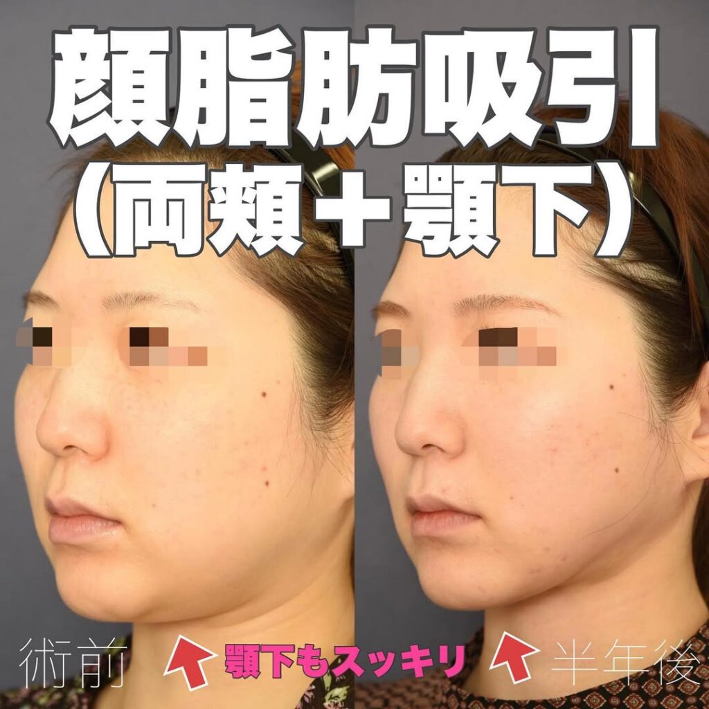 顎 下 脂肪 吸引