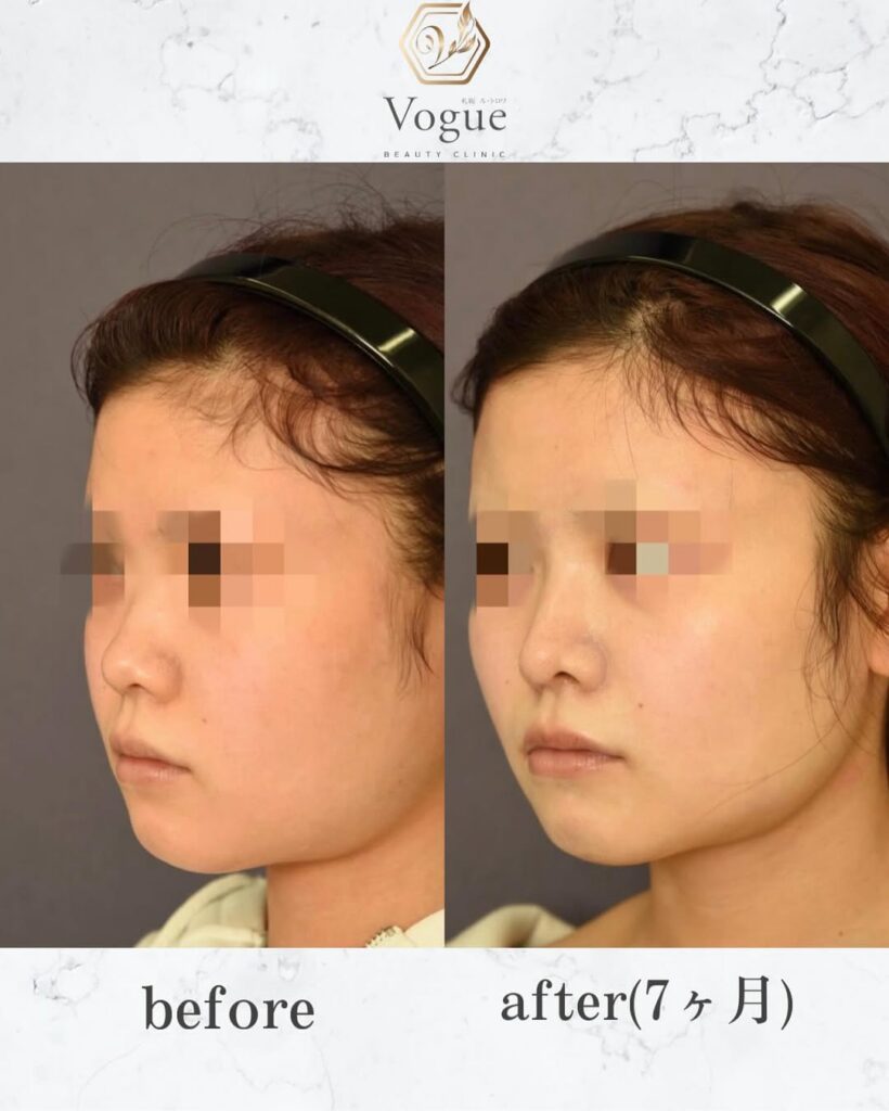 貴族手術（鼻翼基部）