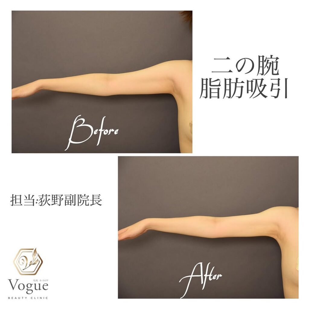 二の腕 脂肪 吸引