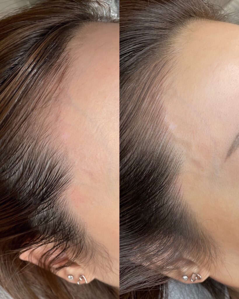 頭皮ヘアライン・スカルプアートメイク