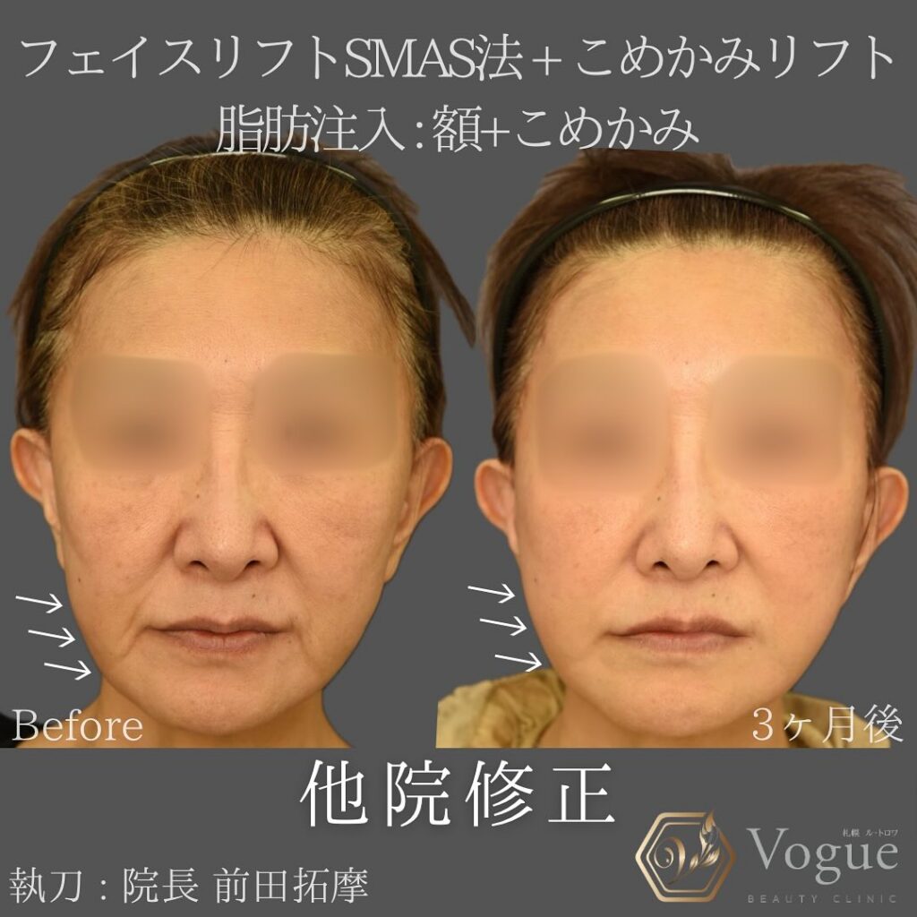 額・こめかみ脂肪注入（フェイスリフト複合手術）