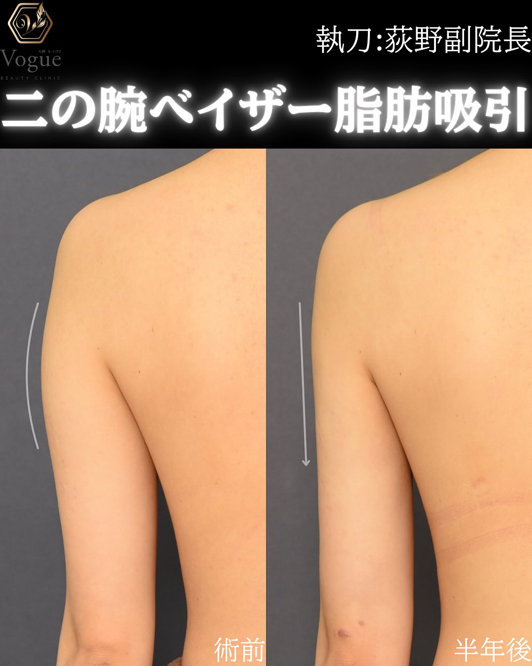 二の腕（上腕）・肩脂肪吸引 - 札幌ル・トロワ ビューティクリニックVogue