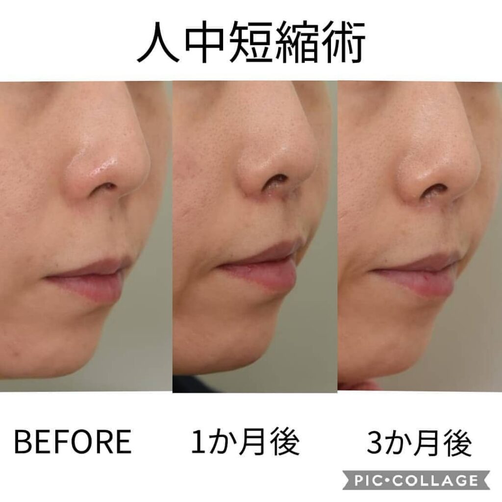 人中短縮