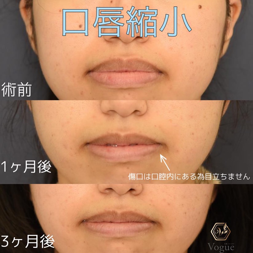 口唇縮小