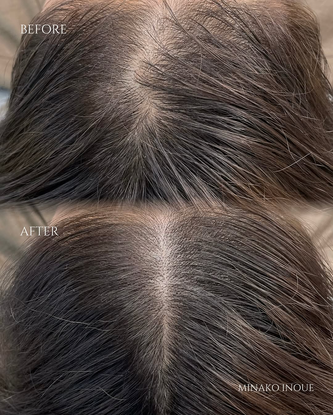 ヘアラインアートメイク（頭頂部・つむじ）