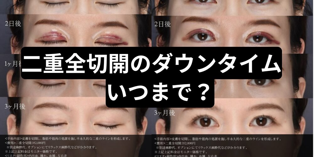 二重全切開ダウンタイムのハム目食い込みいつまで？術後1ヶ月・3ヶ月 