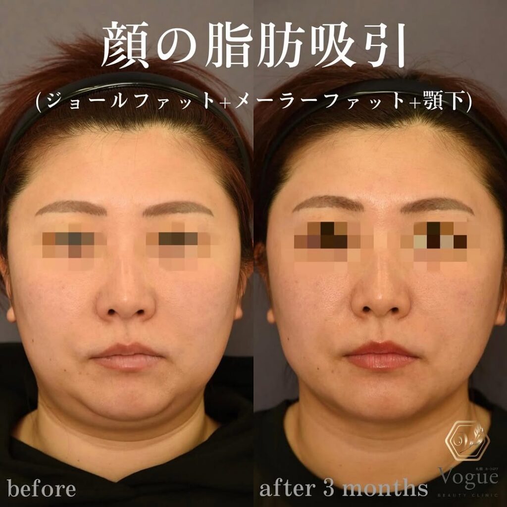 ジョールファット除去